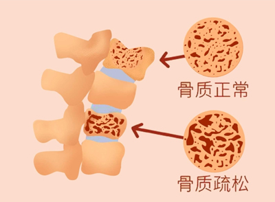 女性绝经就意味着迎来了更年期，更年期身体会出现一系列不适反应，比如身体潮红出汗、情绪变得暴躁、骨质疏松、漏尿、失眠等